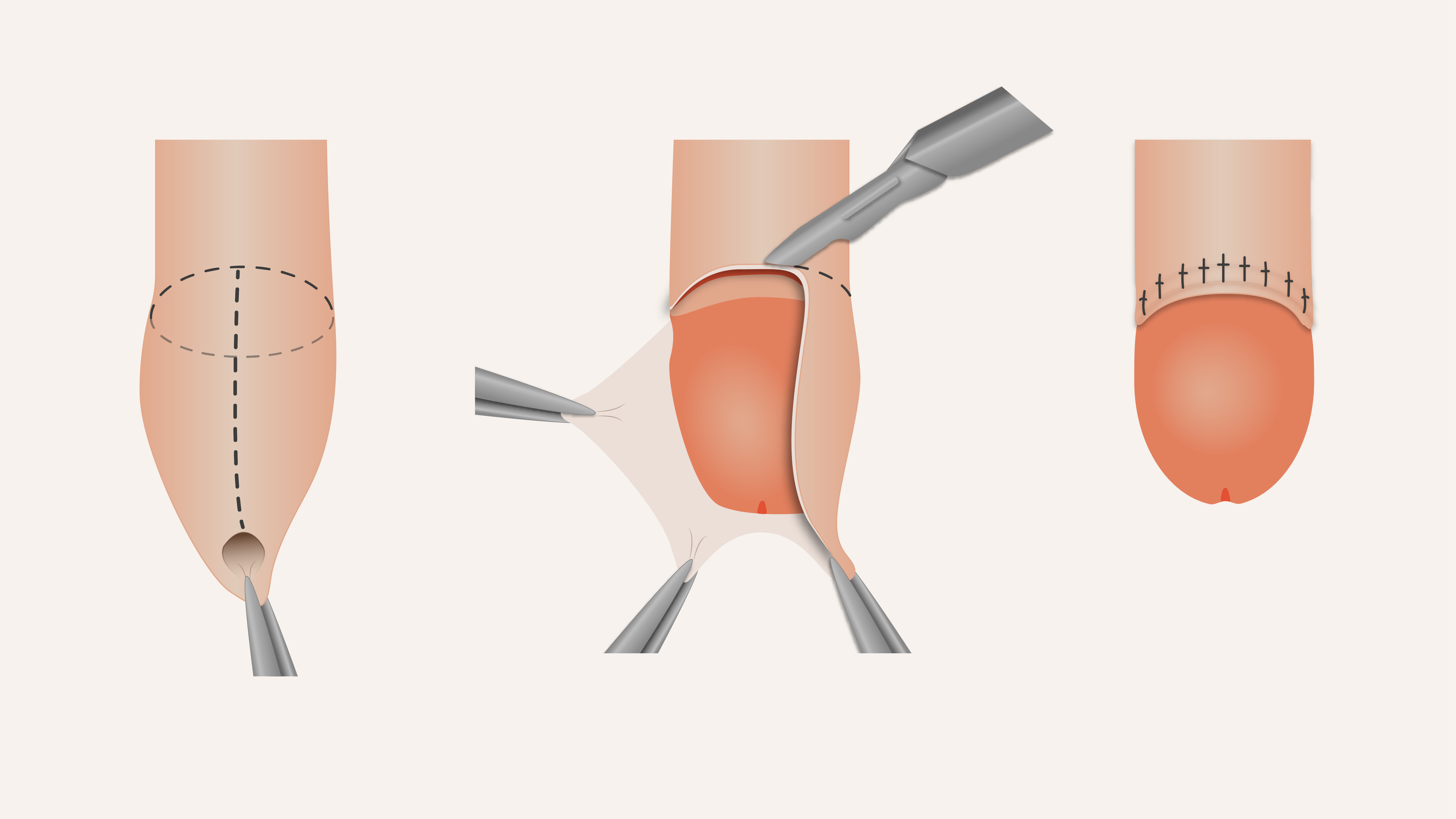 Illustratie van een operatieve besnijdenis van de penis.