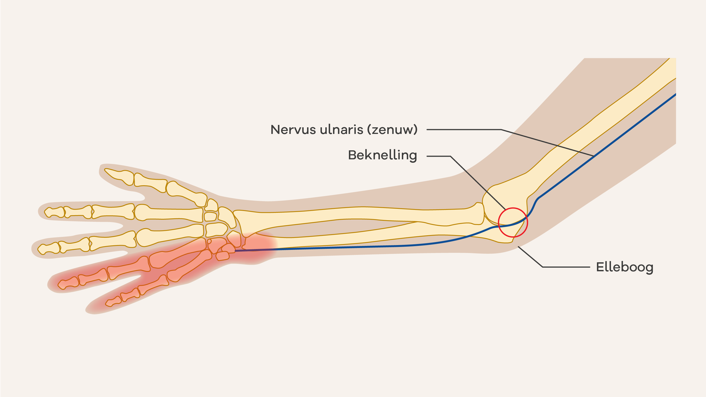 Illustratie van een beknelde zenuw in de elleboog (nervus ulnaris)