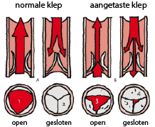 Illustratie aortaklep open en dicht in normale en aangetaste toestand