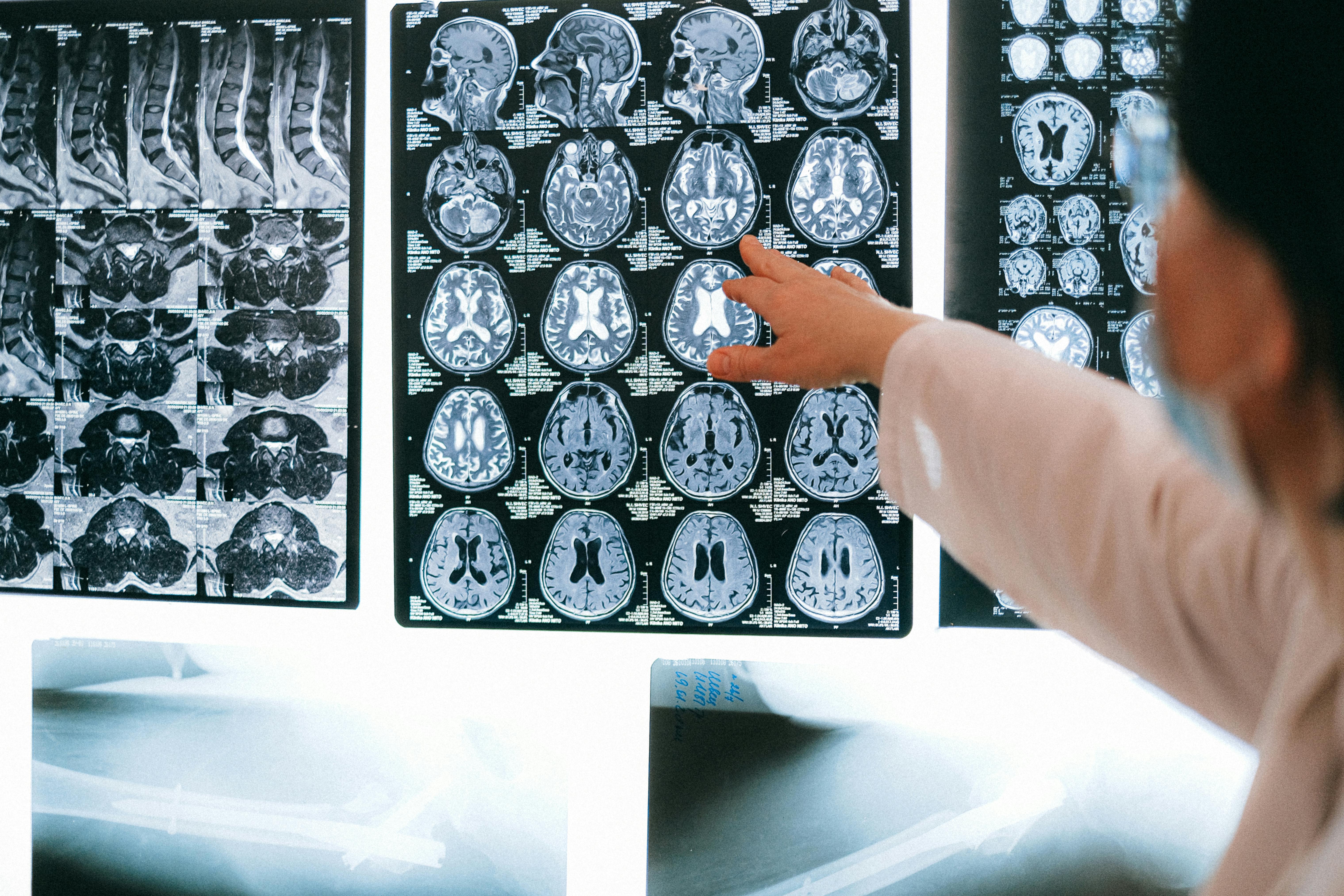 CT-scan van het hoofd